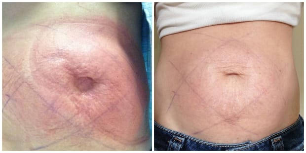 coolsculpting momtrends reshape