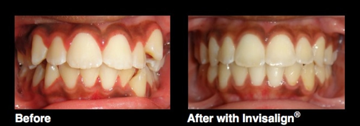 before and after invisalign treatment