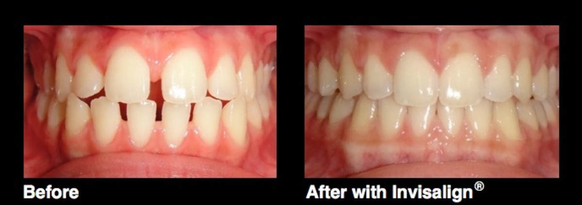 invisalign teeth straightening